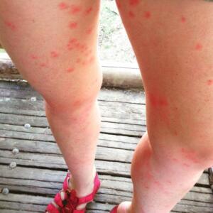 woman's legs with many chigger bites