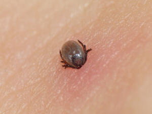 Tick Burrowed into human skin